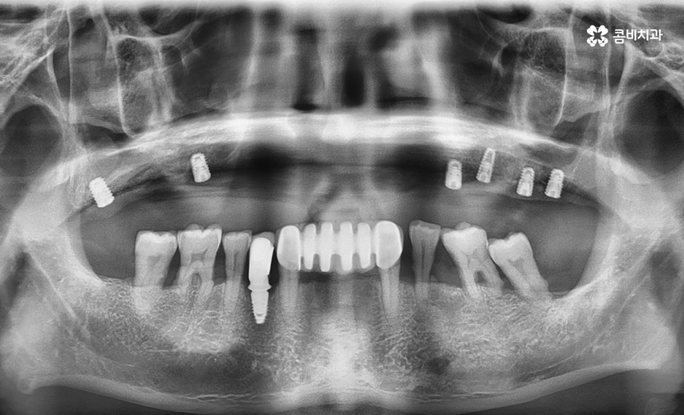 임플란트 수술 여전히 결코 간단하게 볼 수 없는 이유 관련 이미지 3