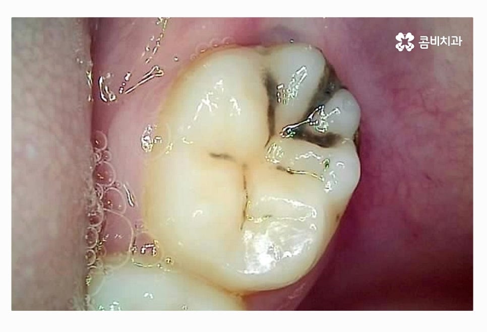 사랑니 충치 현명하게 접근하려면 관련 이미지 6