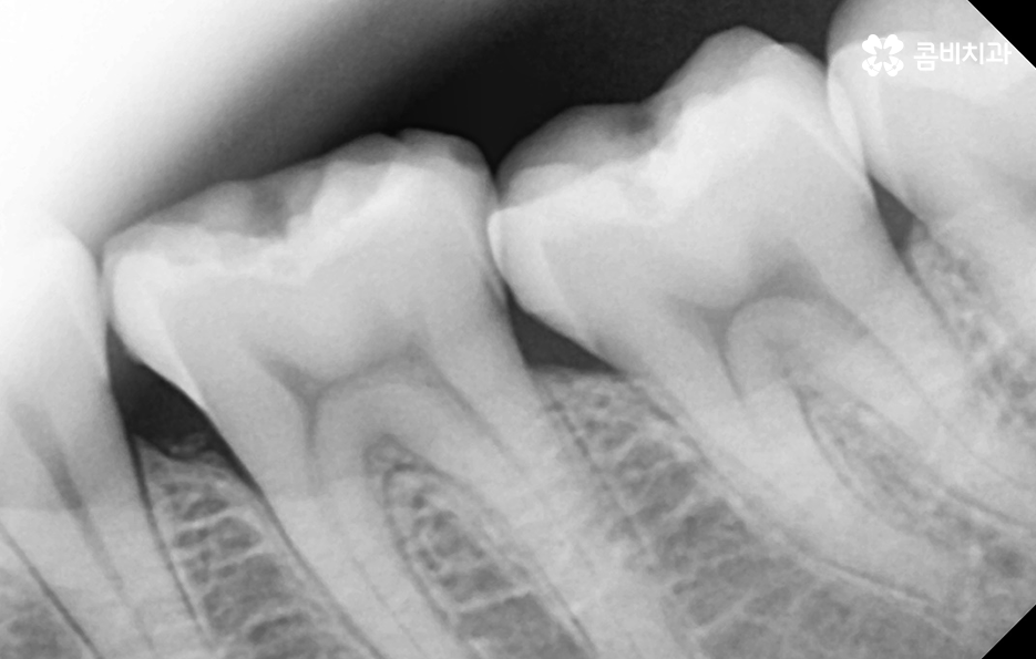어금니 레진 깨짐 변색 안아파도 이렇게 대처하세요 관련 이미지 11