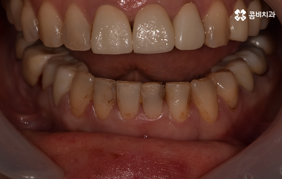아래 앞니깨짐 치료 감쪽같이 해결하려면 관련 이미지 2
