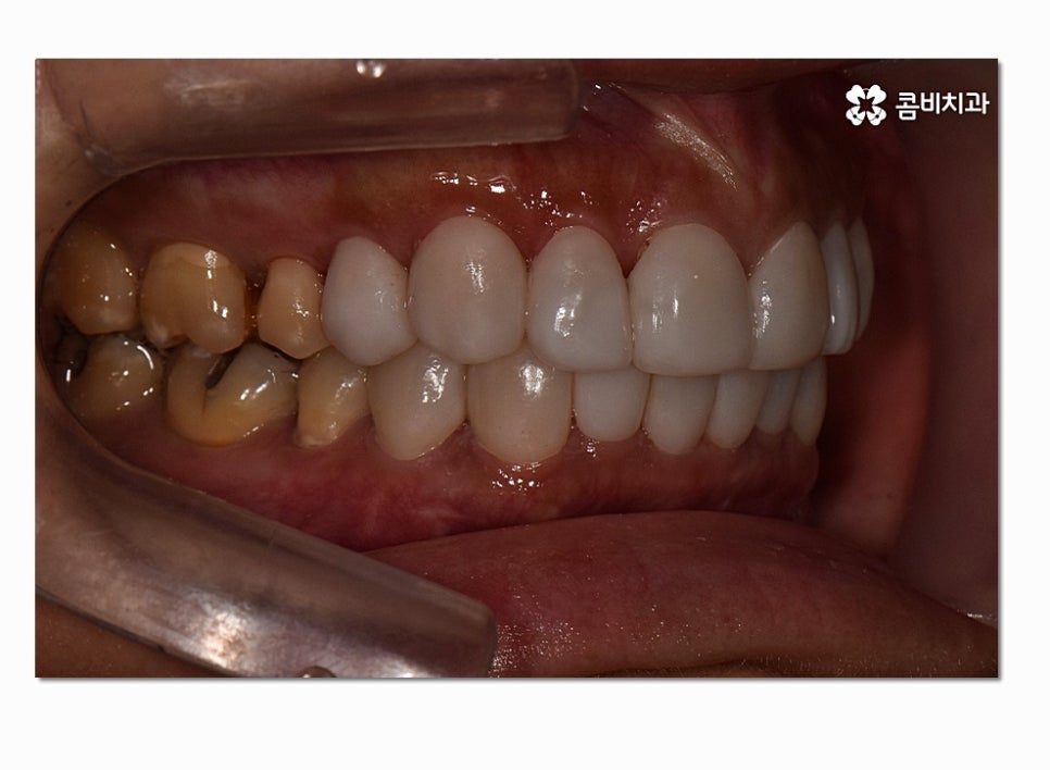 치아라미네이트 누구에게 필요할지 궁금하다면 관련 이미지 5