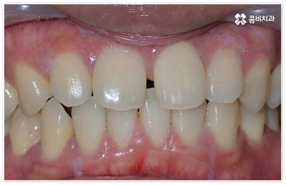 앞니 벌어짐 고치고 싶어요 관련 이미지 3