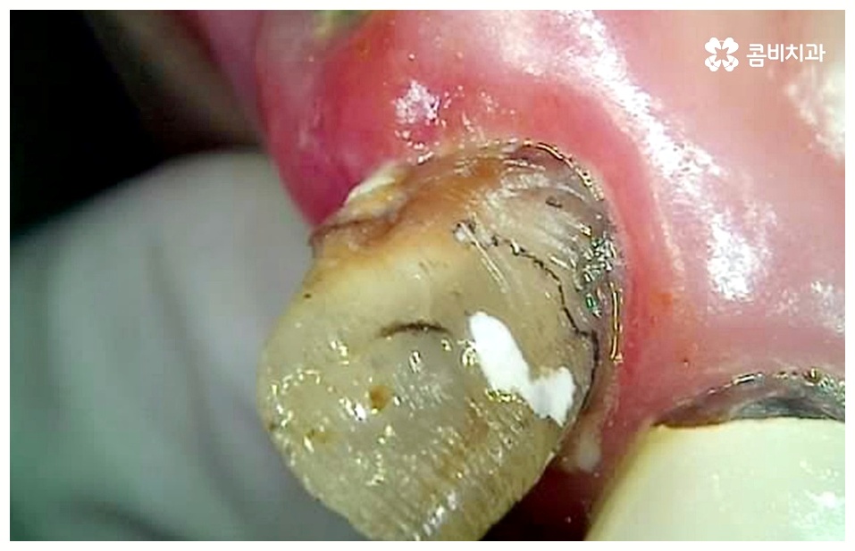 임플란트 치료기간 중점을 두어야 할것은 관련 이미지 1