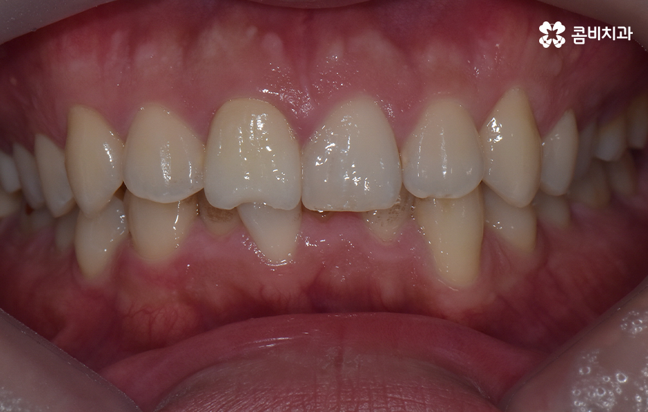 아랫니교정 이렇게만 파악하시면 됩니다 관련 이미지 1