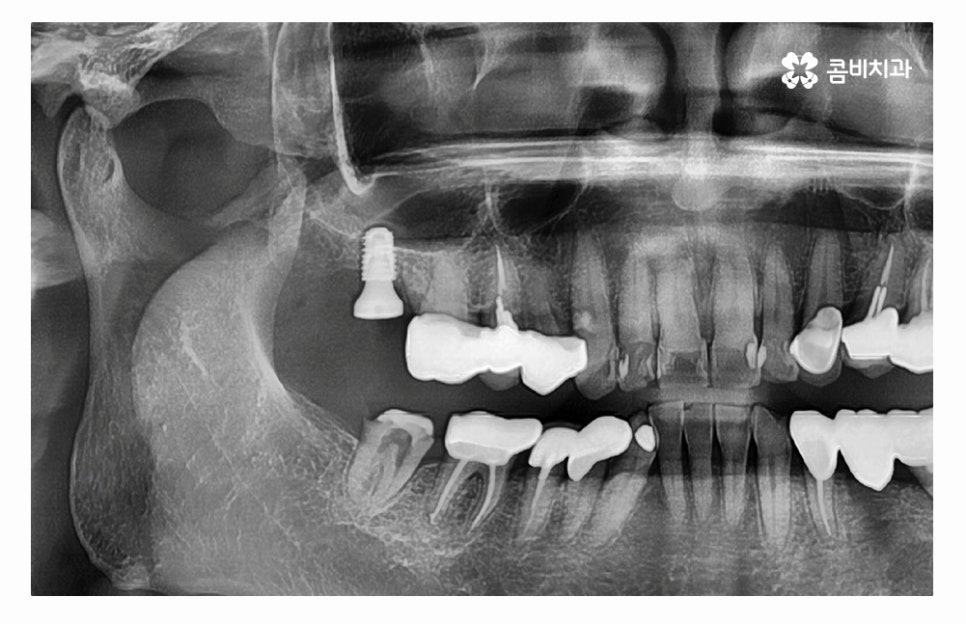 임플란트수술 제대로 알고 선택하려면 관련 이미지 6
