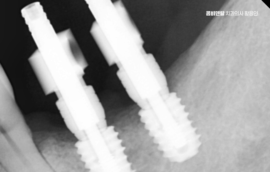 어르신 임플란트 지원 현명하게 활용하려면 관련 이미지 7