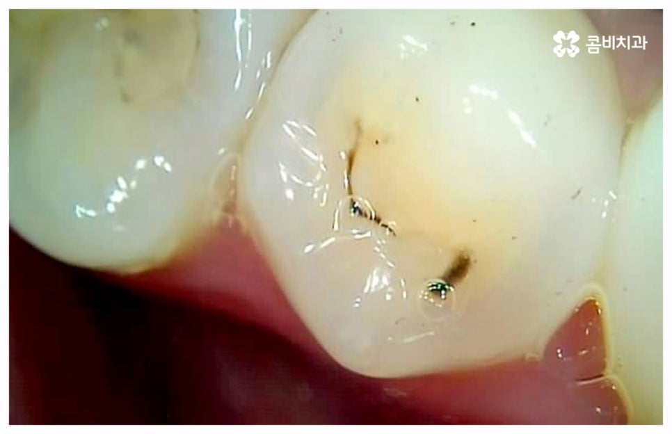 치통이 심할때 어떻게 해야하나요 관련 이미지 9