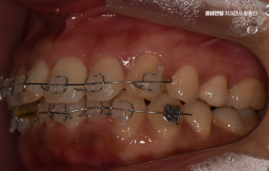 앞니 부분 교정 간단하니까 좋은건가요 관련 이미지 9
