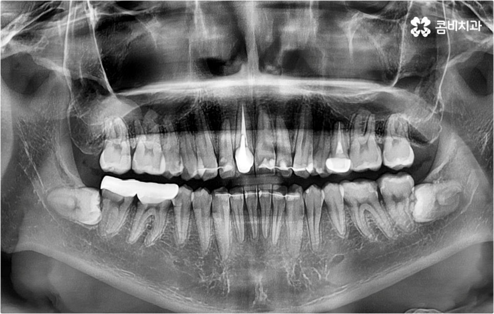 덧니교정 하고싶다면 관련 이미지 11