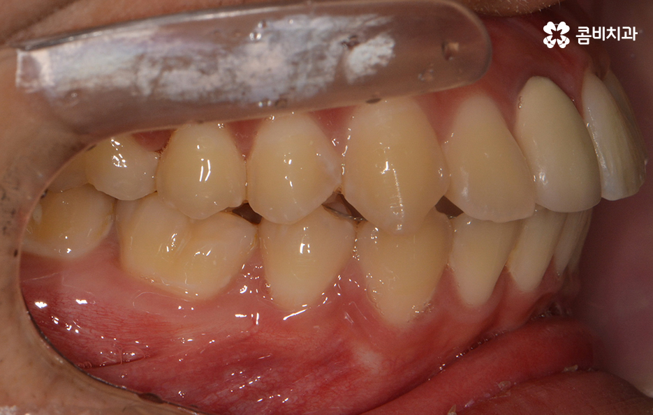 덧니교정 불편함이 느껴지지 않더라도 관련 이미지 13