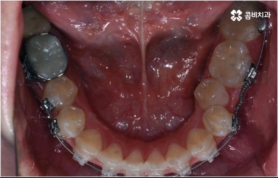 성인 치아교정 기간 걱정이 앞서나요 관련 이미지 11