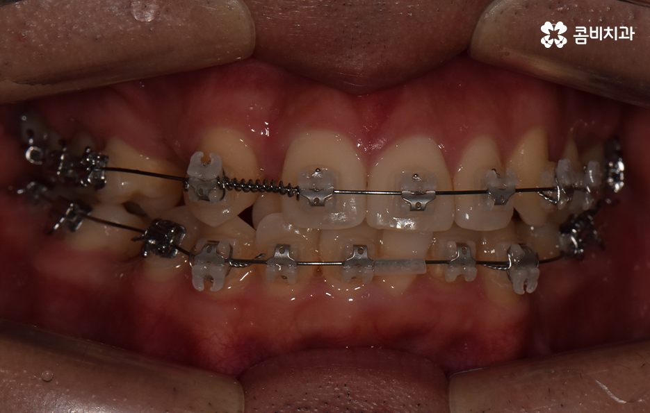 덧니 발치교정으로 교정할 때 치아가 이렇게 이동해요 관련 이미지 8