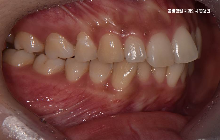 앞니 틀어짐 교정 이렇게 파악하세요 관련 이미지 4