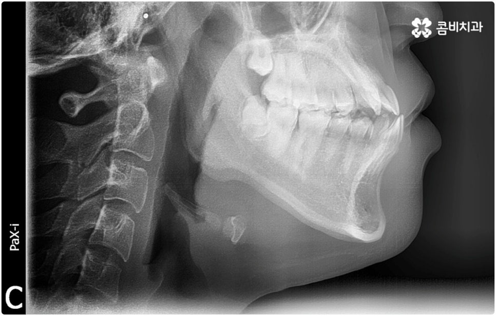 부정교합 3급 고치는 방법은 관련 이미지 1