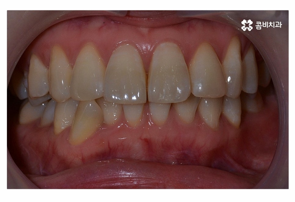 치아설측교정 가능한지 궁금하다면 관련 이미지 1