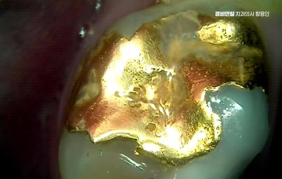 어금니 충치 단계 미리 알아차리려면 관련 이미지 5
