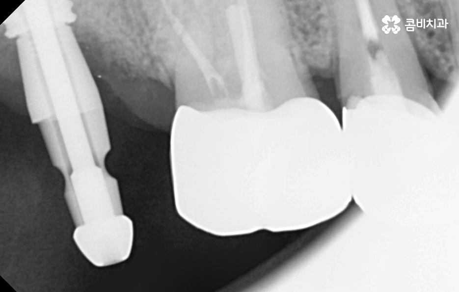 어금니 충치 발치 결국 뽑아야 할때와 살릴 수 있는 케이스 관련 이미지 8