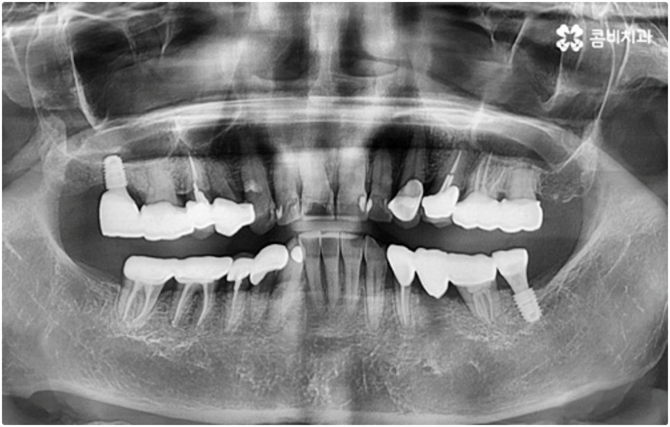 어금니임플란트 살펴볼 사항들은 무엇인가요? 관련 이미지 8