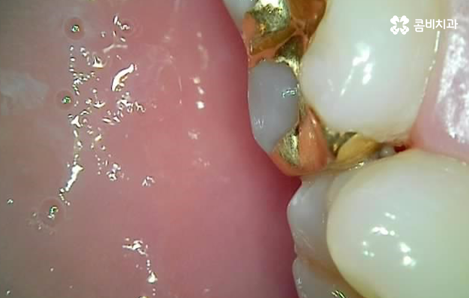 치아 사이 충치 까다로운 이유부터 알아보시죠 관련 이미지 8