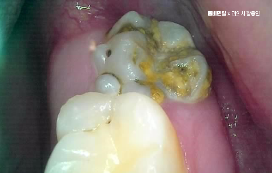 사랑니 발치 후 충치 치료 둘다 준비하려면 관련 이미지 4