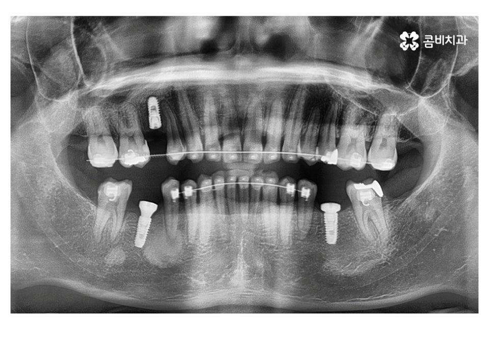 20대임플란트 잦아지는 이유를 알아본다면 관련 이미지 11
