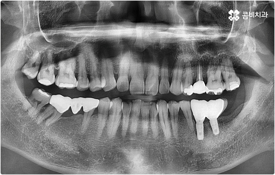 20대임플란트 남의일이 아니라면 관련 이미지 10
