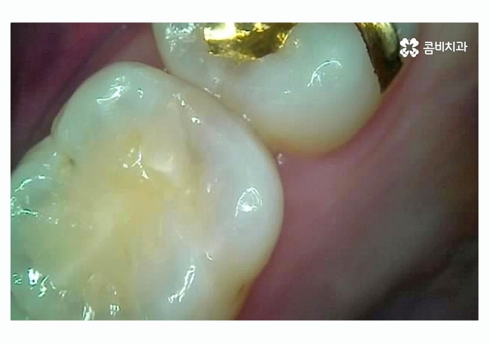 충치 떼우기 스무살이후에 조심해야 할 점은? 관련 이미지 6