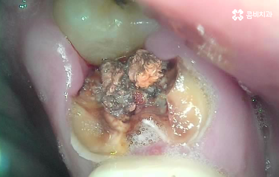 어금니 충치 발치 결국 뽑아야 할때와 살릴 수 있는 케이스 관련 이미지 2