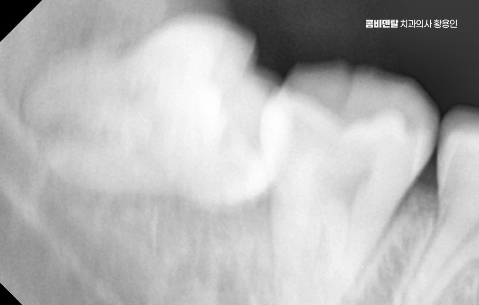 사랑니 발치 후 충치 치료 둘다 준비하려면 관련 이미지 7