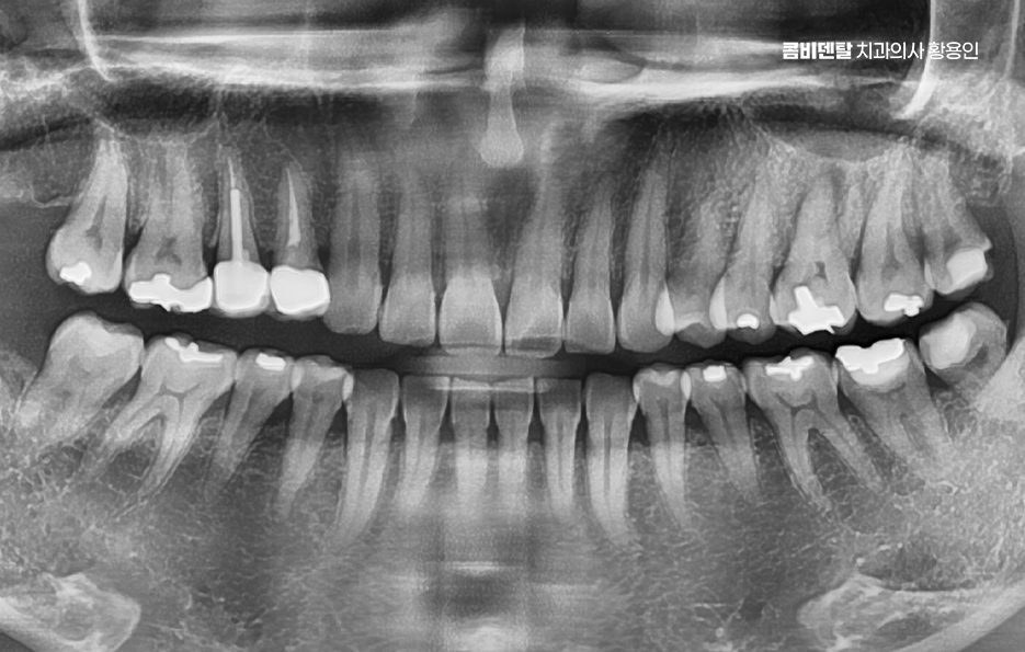 인레이 치료 후 신경치료 이유가 궁금하다면 관련 이미지 1