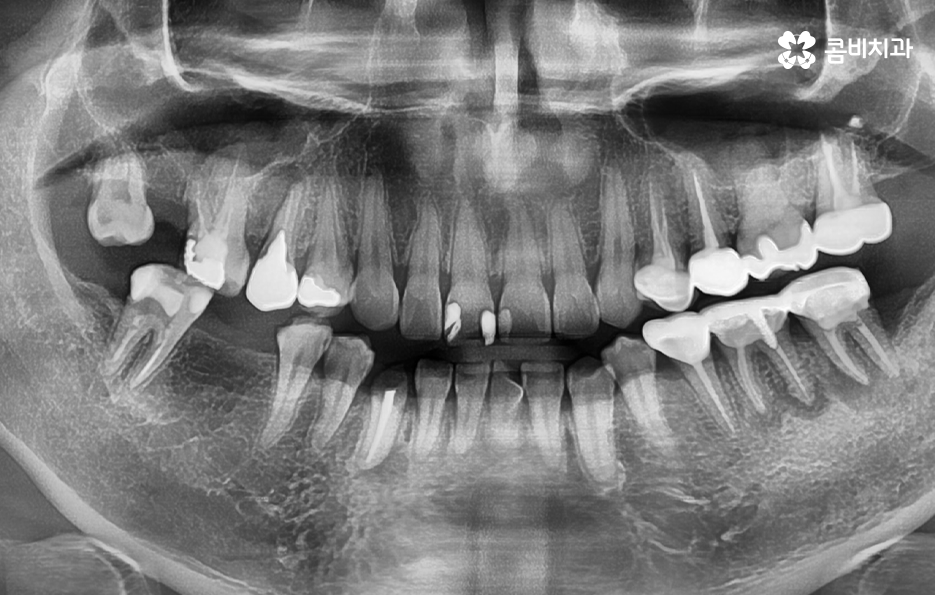 충치 단계 어떻게 분류하고 치료해야 하나요 관련 이미지 1