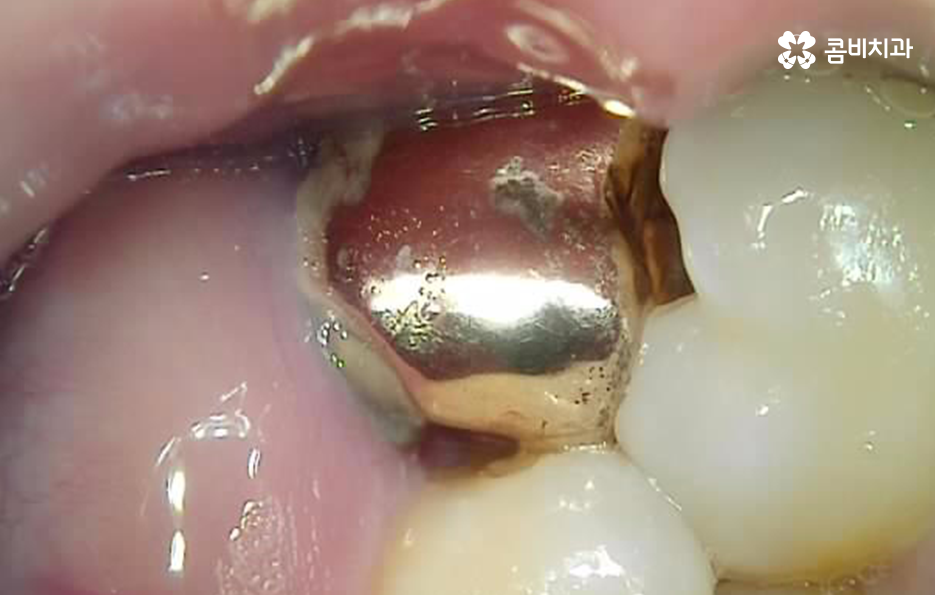 어금니 발치후 임플란트 이런점을 주의합시다 관련 이미지 2