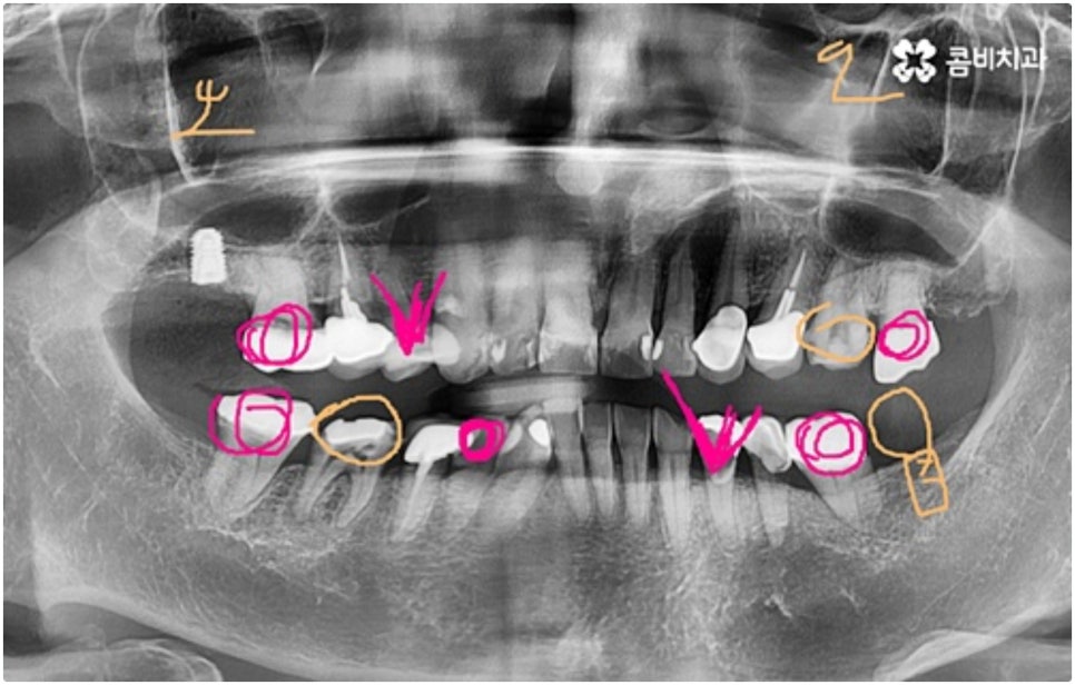 어금니임플란트 살펴볼 사항들은 무엇인가요? 관련 이미지 2