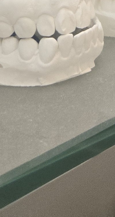 앞니 틀어짐 부분교정 얼마나 걸릴까 관련 이미지 45