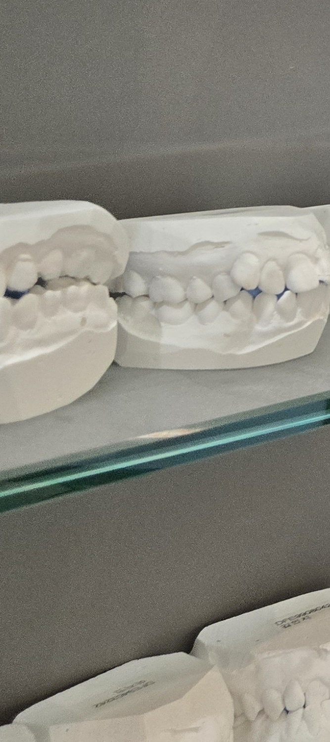 오래된 보철물 아말감 교체 어떠한 케이스일까 관련 이미지 17