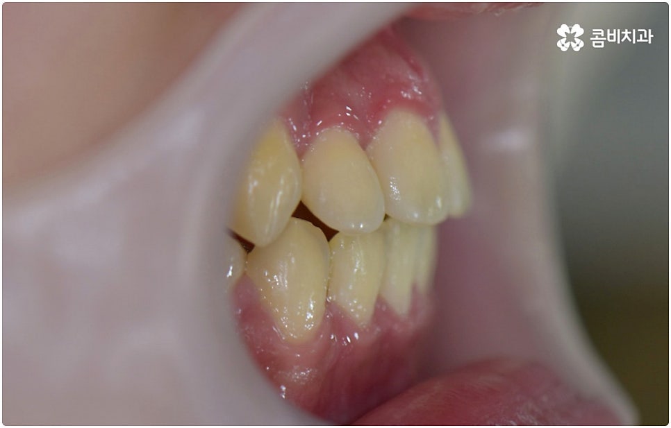 부정교합 3급 고치는 방법은 관련 이미지 12