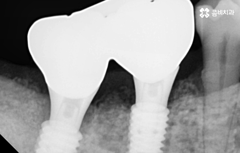 건강보험 임플란트 적용 받기 전에 알아두세요 관련 이미지 8
