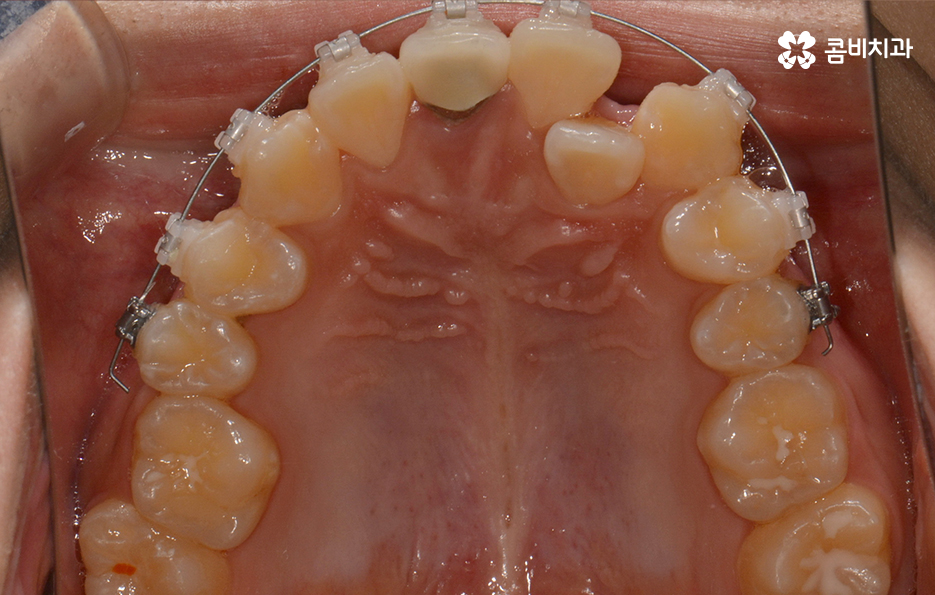 덧니교정 불편함이 느껴지지 않더라도 관련 이미지 10