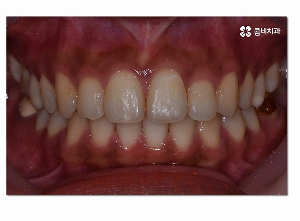 앞니 부분교정 오래 걸리지 않고 원하는 부위만 관련 이미지 10