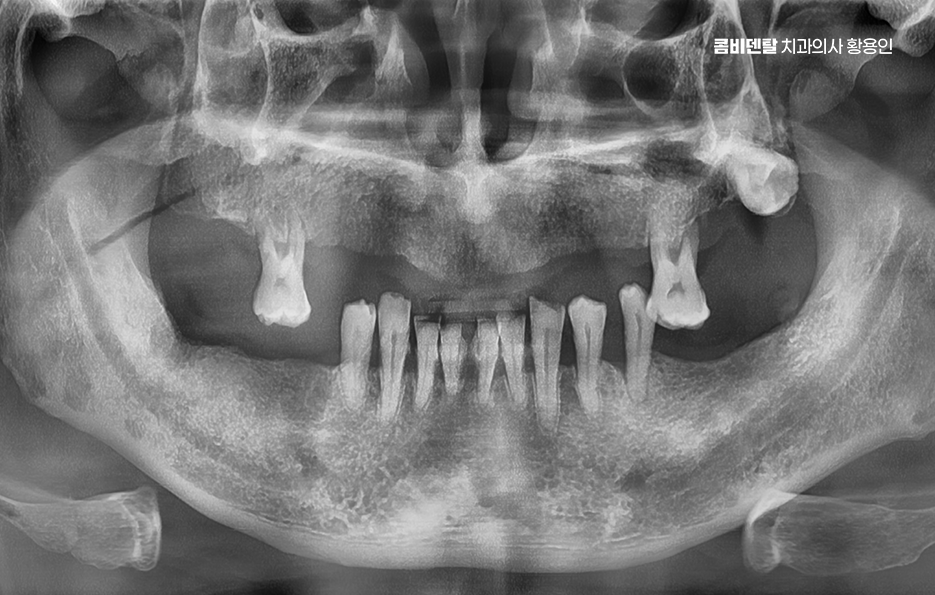 윗니 전체 임플란트 뭐부터 해야할까 관련 이미지 1