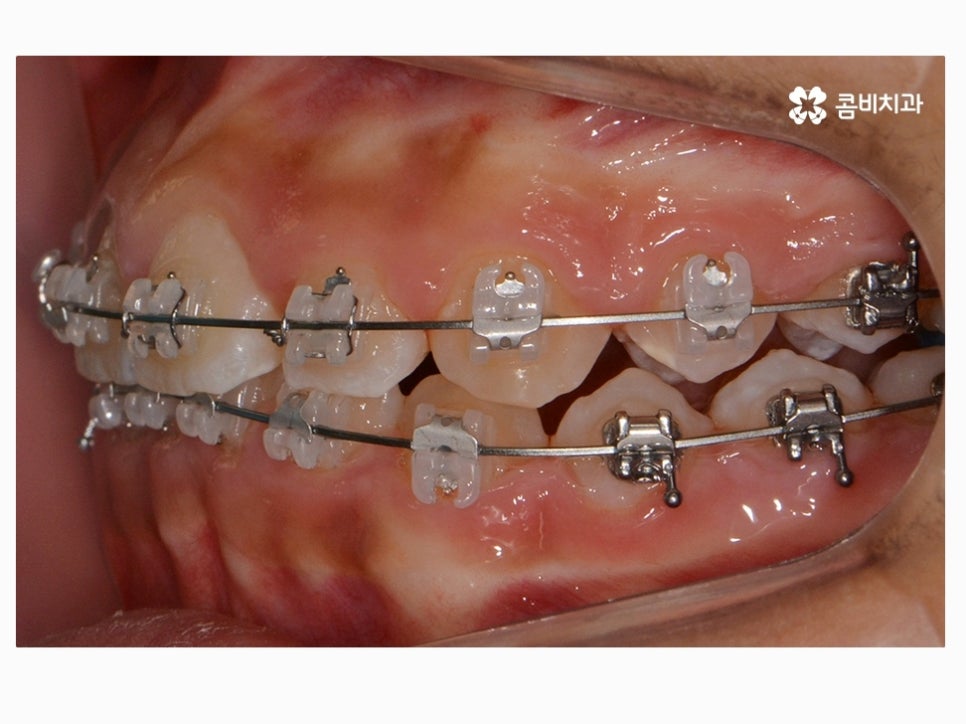 과개교합교정 어릴때 고쳐주면 좋은 사례 관련 이미지 10
