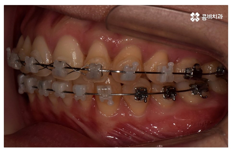 덧니교정 정확하게 알아보려면 관련 이미지 12