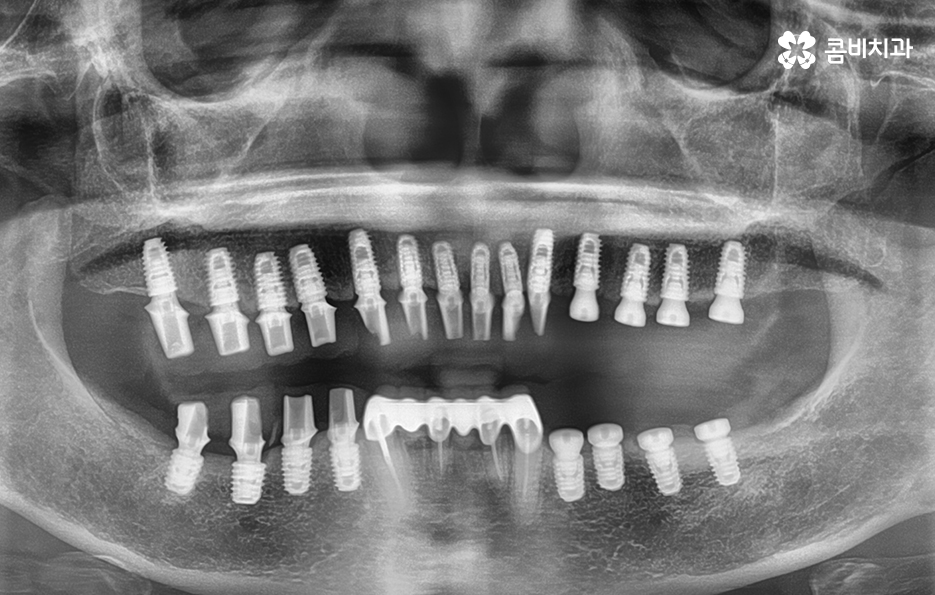 65세이상임플란트 고령이기에 간과하지 말아야 할 사항은 관련 이미지 6
