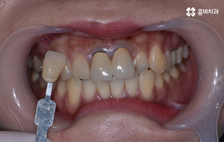 치아 깨짐 다시 튼튼하게 수복하기 위한 방법 관련 이미지 7