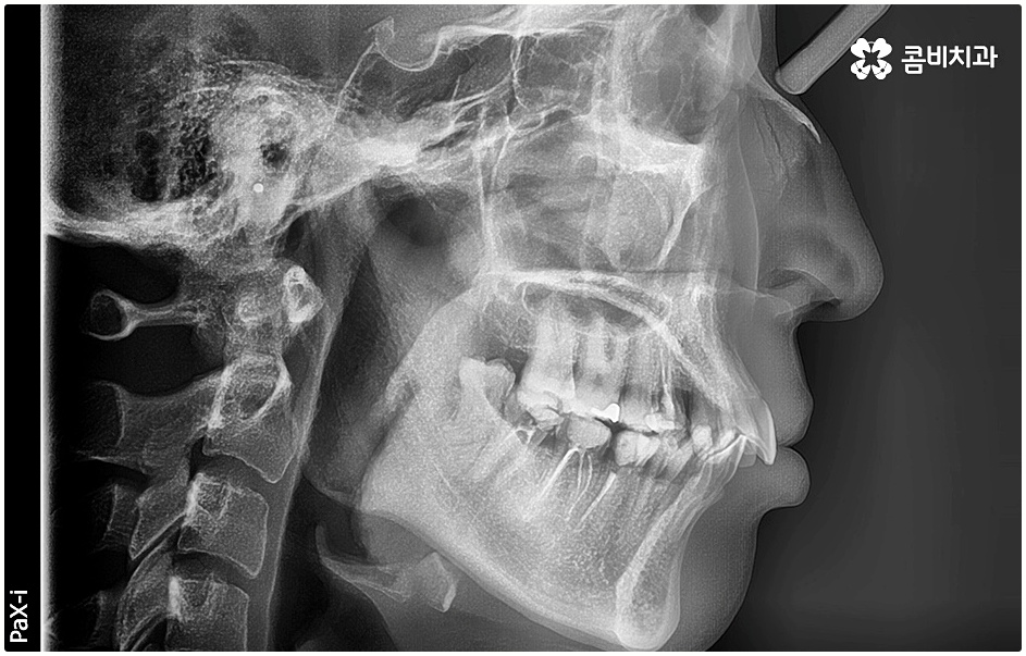 돌출치아교정 언제가 좋을까요 관련 이미지 1