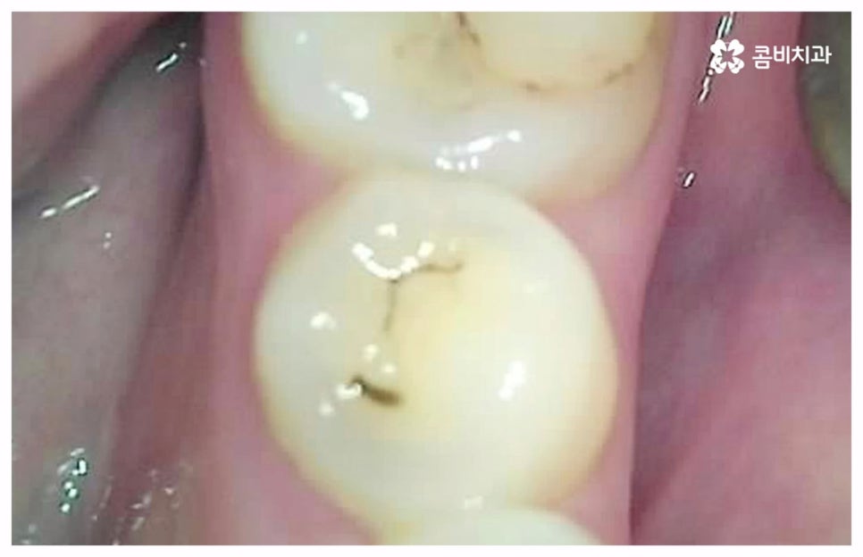 치통이 심할때 어떻게 해야하나요 관련 이미지 6