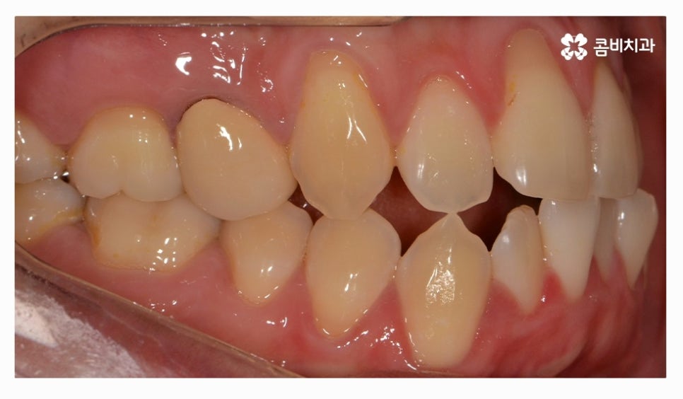 클리피씨교정 올바르게 판단하려면 관련 이미지 2