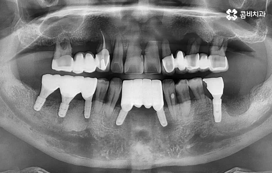 노인임플란트 이것만큼은 기억하세요 관련 이미지 9