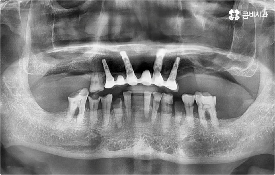 전악임플란트 고려할 사항들은 관련 이미지 1