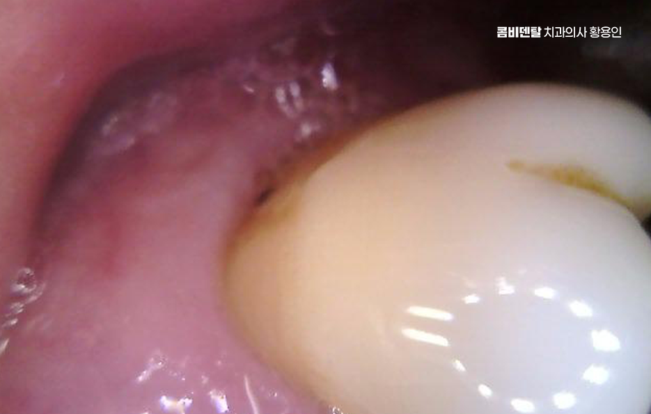 치경부마모증 치료 과정 신중하게 준비하려면 관련 이미지 8